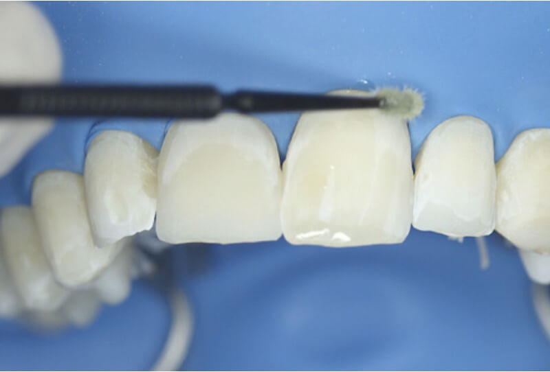 Schritt 4: Bonding: Auftragen von ONE COAT 7 UNIVERSAL nach Anwendung der Totaletch-Technik.