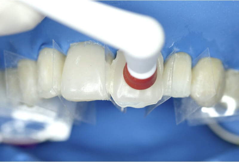 Schritt 6: Platzierung: Das BRILLIANT COMPONEER wird auf dem Zahn positioniert und anschließend polymerisiert.