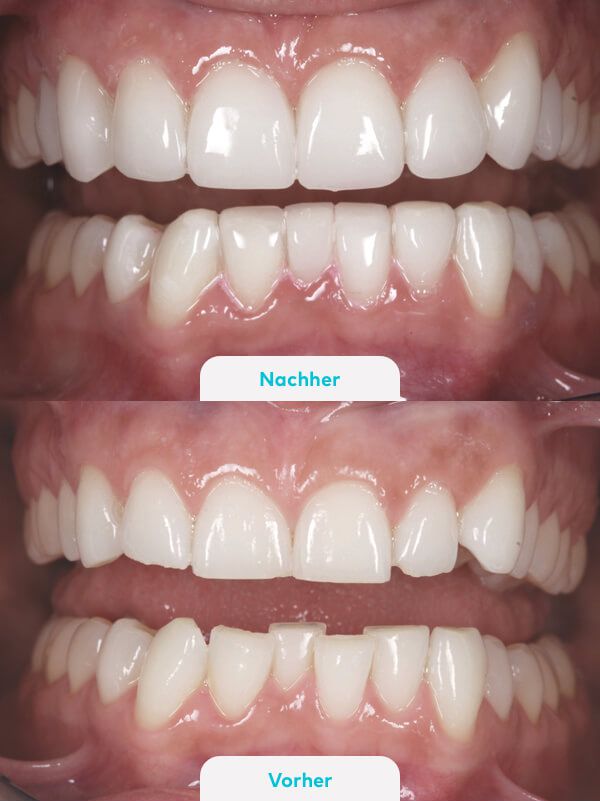 Veneers